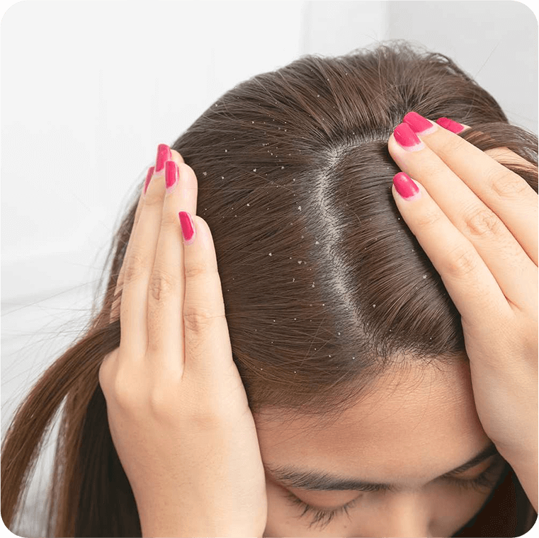 Who Is The Dandruff Relief Therapy For?