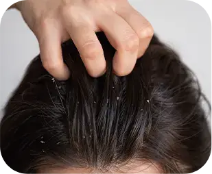 Oily scalp or dandruff issues.